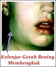 Obat Kelenjar Getah Bening Bengkak